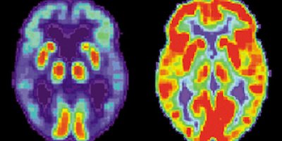 Lundaforskare ifrågasätter orsaken till Alzheimer