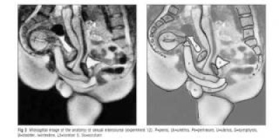 MRI-bilder av könsorganen under samlag