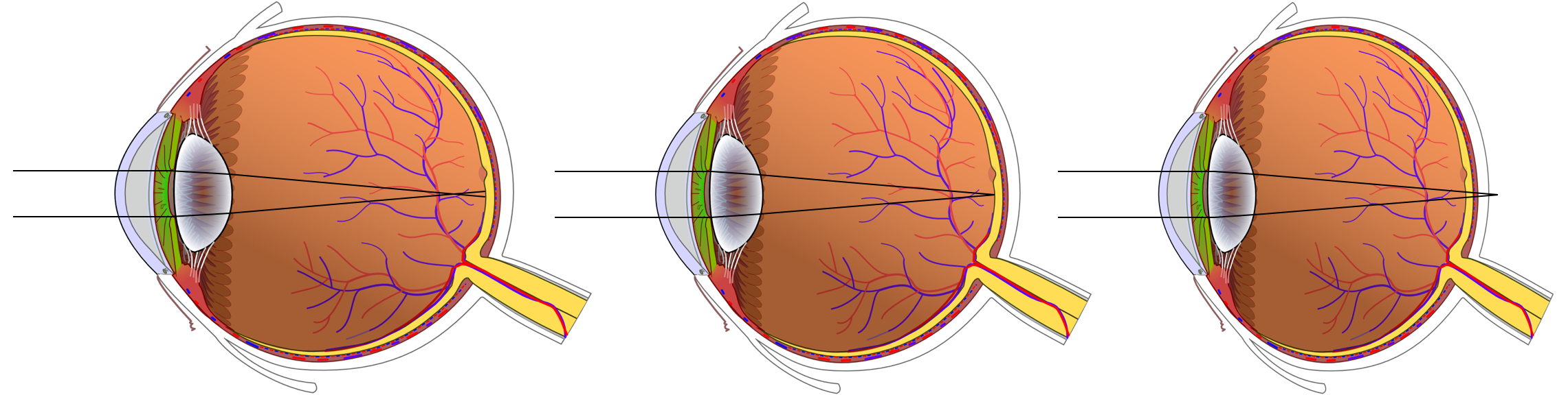 I ett närsynt öga (vänster) bryts ljusstrålarna framför näthinnan. I ett översynt öga (höger) bryts ljusstrålarna bakom näthinnan. Ett normalseende öga i mitten. Ögonens deformation har överdrivits. 